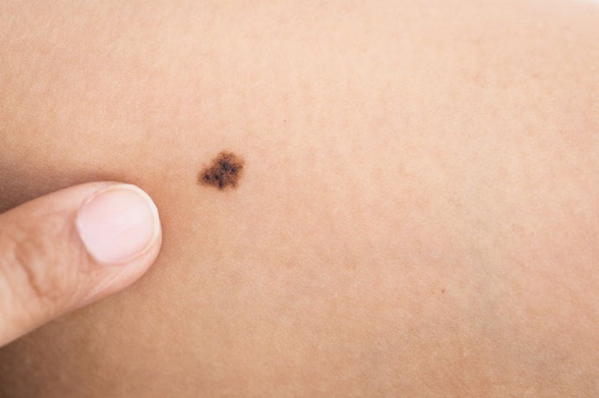 300 dermatologues vont proposer le dépistage gratuit du cancer de la peau